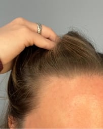 Brunette woman's hairline, before Curology use.